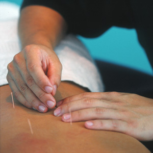 Acupuncture Needles